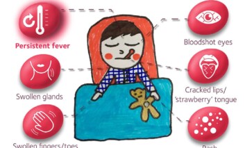 Child’s drawing of the Kawasaki Disease Symptoms